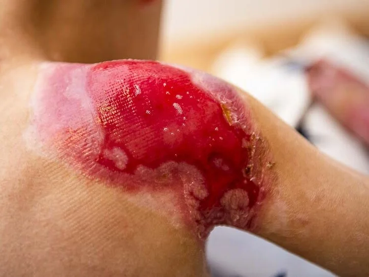 Epidermolysis bullosa