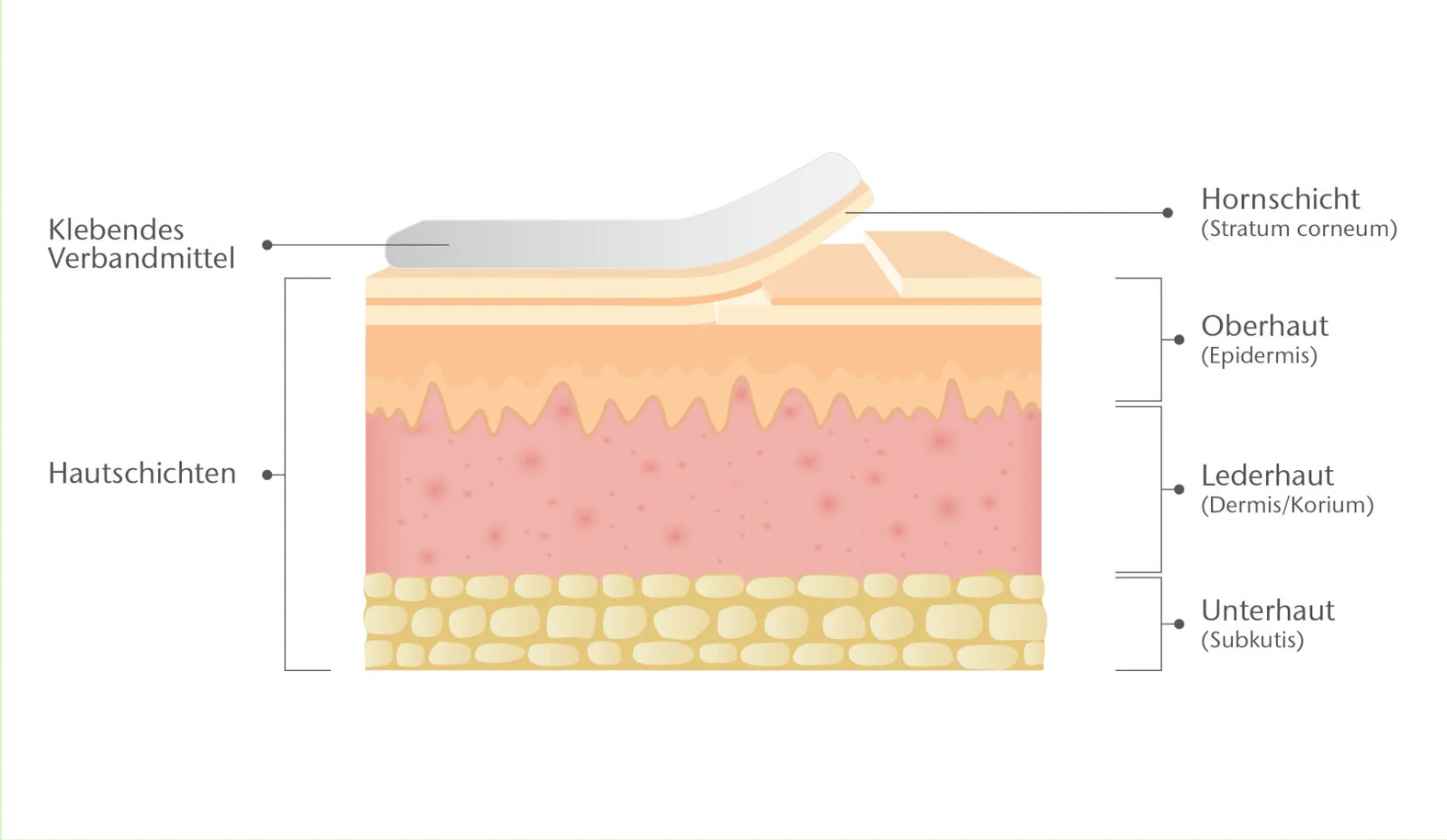 Medical AdhesiveRelated Skin Injuries (MARSI) unterschätzt, vermeidbar