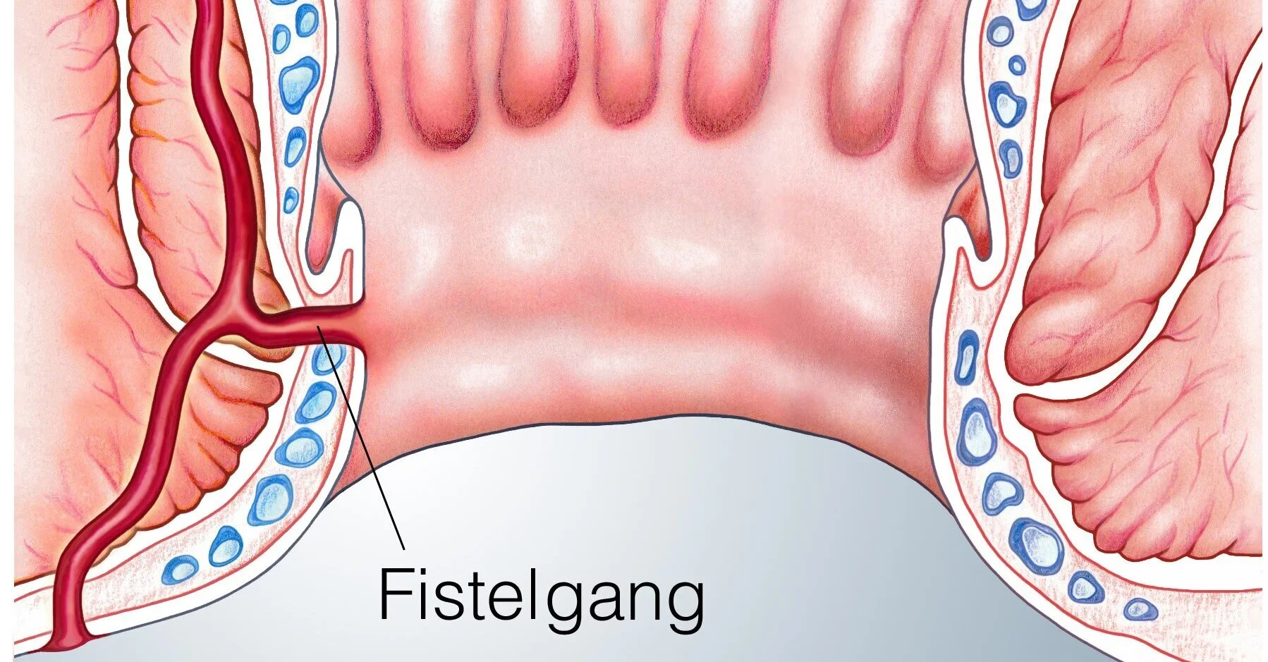 Fistel Zwischen Darm Und Blase Symptome www.draco.de