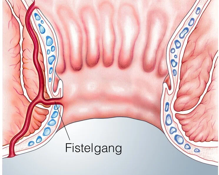 Analfistel, perianale Fistel, schematische Darstellung eines Fistelgangs Fisteln