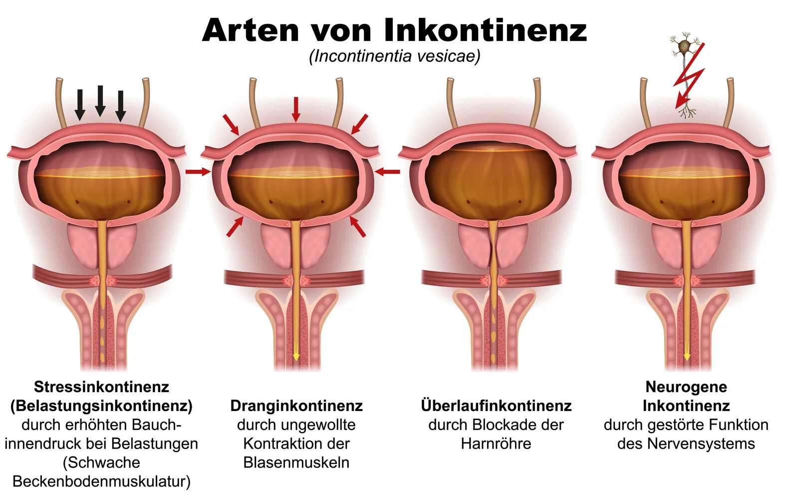 Arten der Harninkontinenz, schematische Darstellung