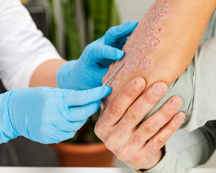 Diagnostik: Untersuchung einer Dermatitis ABCDE-Regel: Leitfaden zur Diagnostik chronischer Wunden