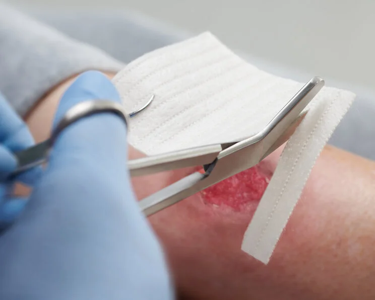 DracoHydrofaser - Applikation der Hydrofaser Hydrofaser – Gelbildender Faserverband