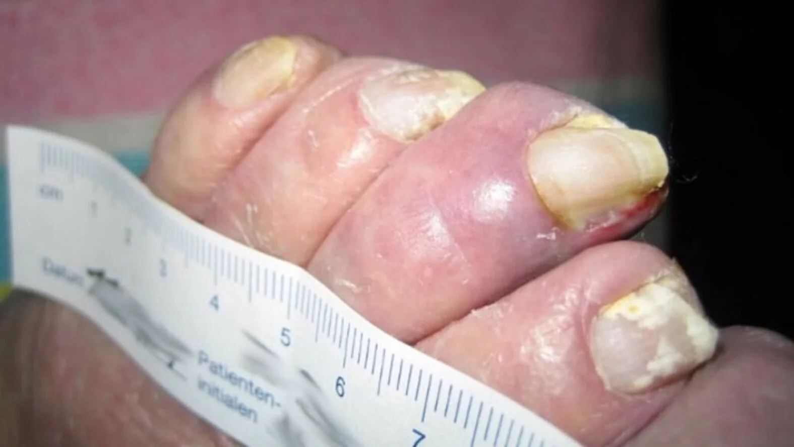 Zehennägel mit Angiopathischer-Fuß-Nagelmykose