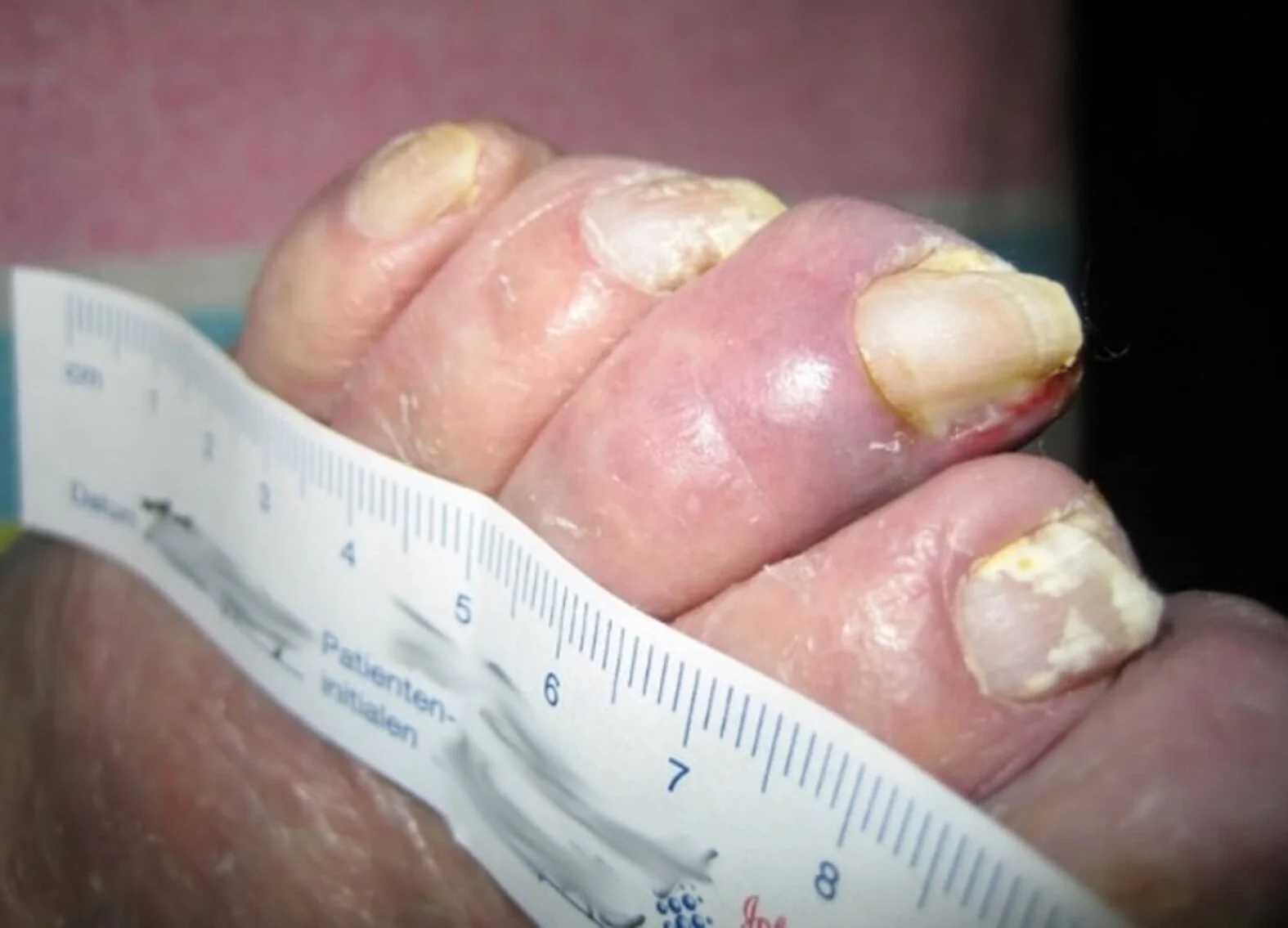 Zehennägel mit Angiopathischer-Fuß-Nagelmykose