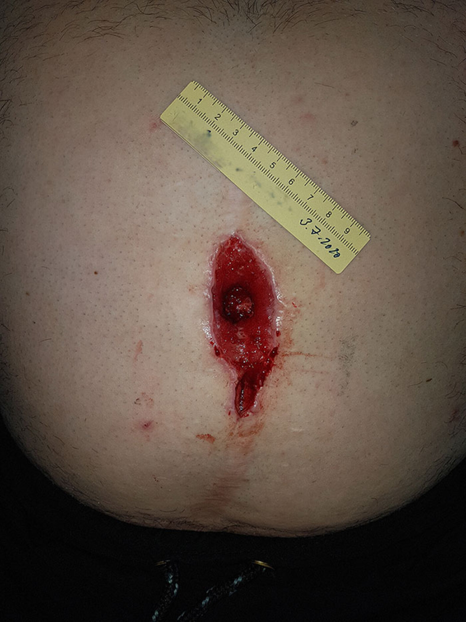 Nahtdehiszenz am Bauch