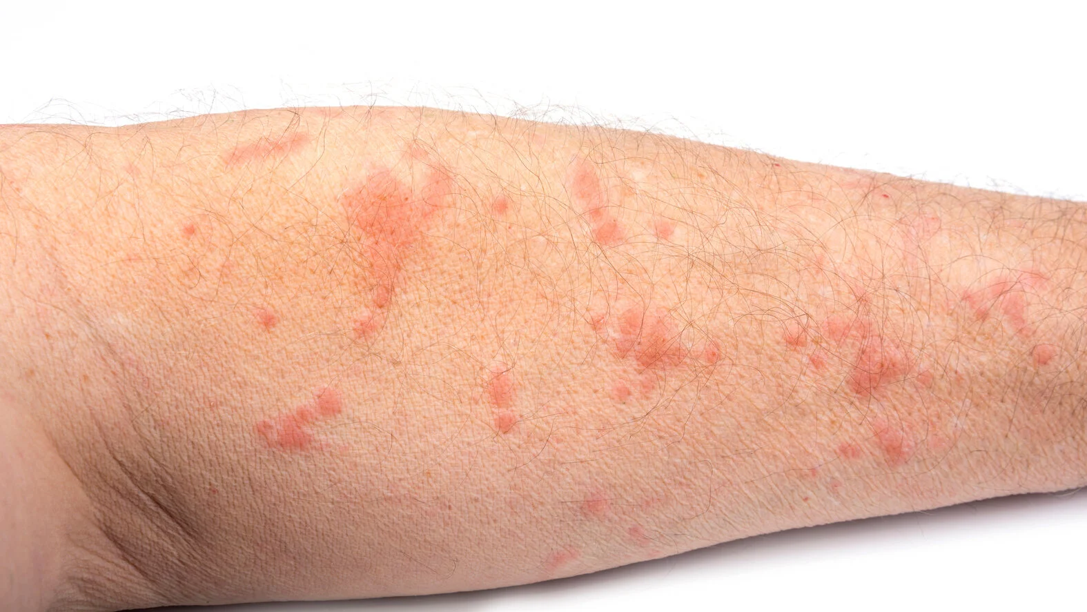 Scabies erkennen und behandeln: Die Hauterkrankung Krätze