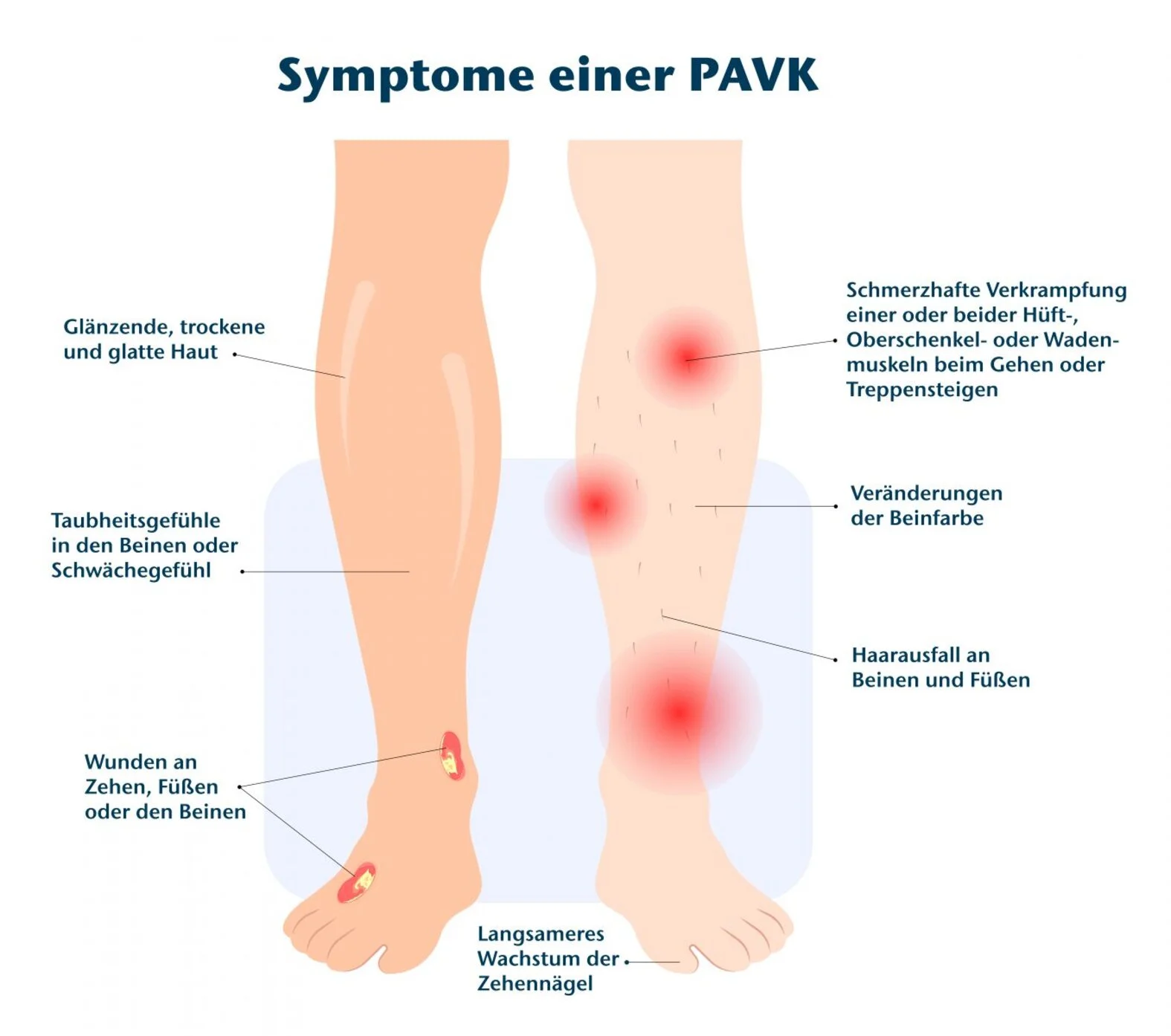 Symptome einer pAVK, grafische Darstellung