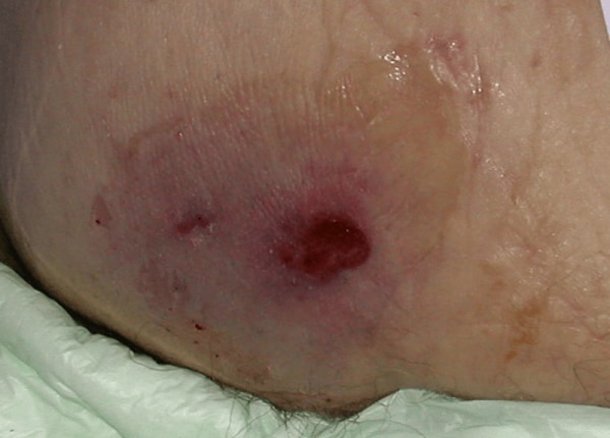 Dekubitus Kategorie 2 – Teilverlust der Haut