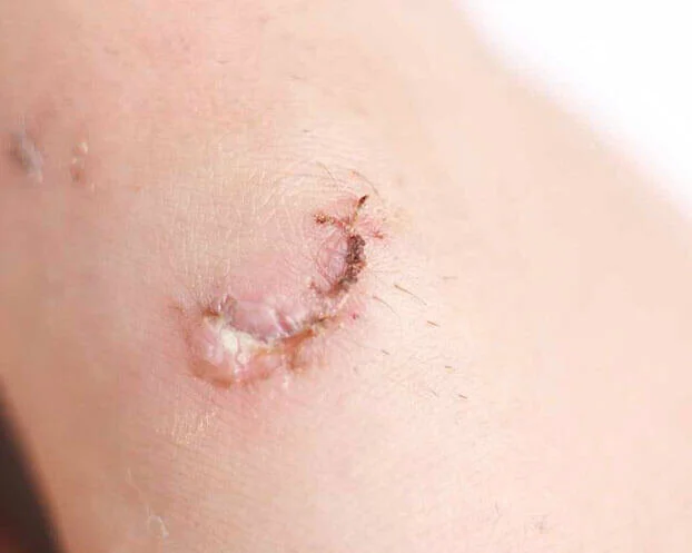 Iatrogene am Finger Iatrogene Wunden