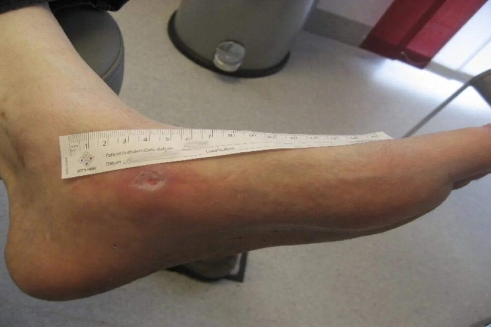 CharcotFuß oder CharcotArthropathie beim Diabetischen Fuß