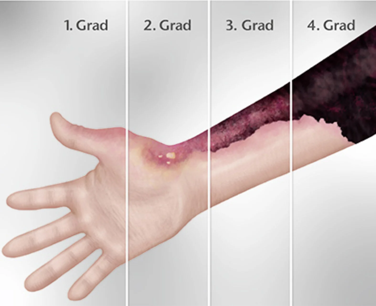 Verbrennungen, Verbrühungen – Gradeinteilung und Versorgung