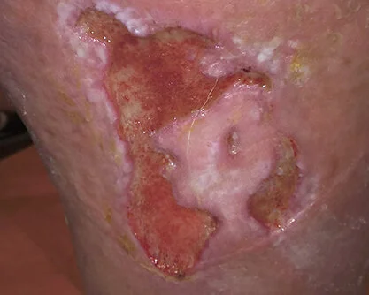 Mazerierender Wundrand Mazeration: Behandlung mazerierender Wunden, Prophylaxe