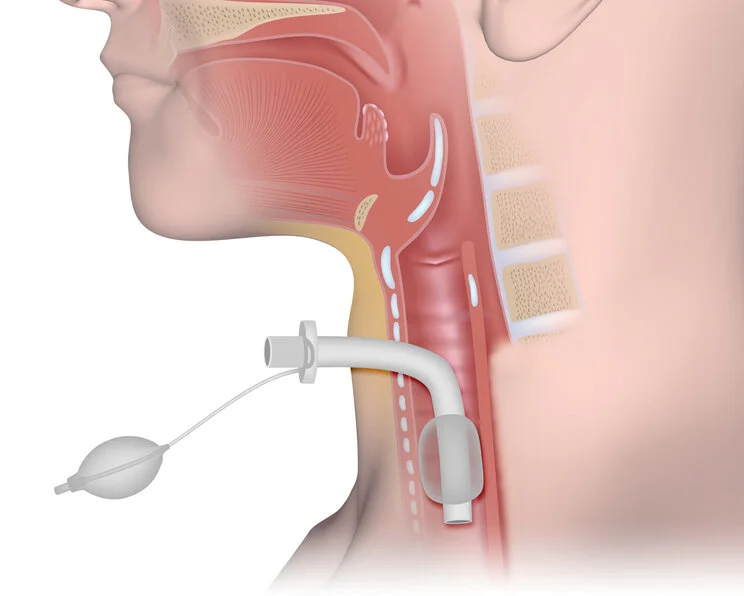 Tracheostoma, schematische Darstellung Tracheostoma