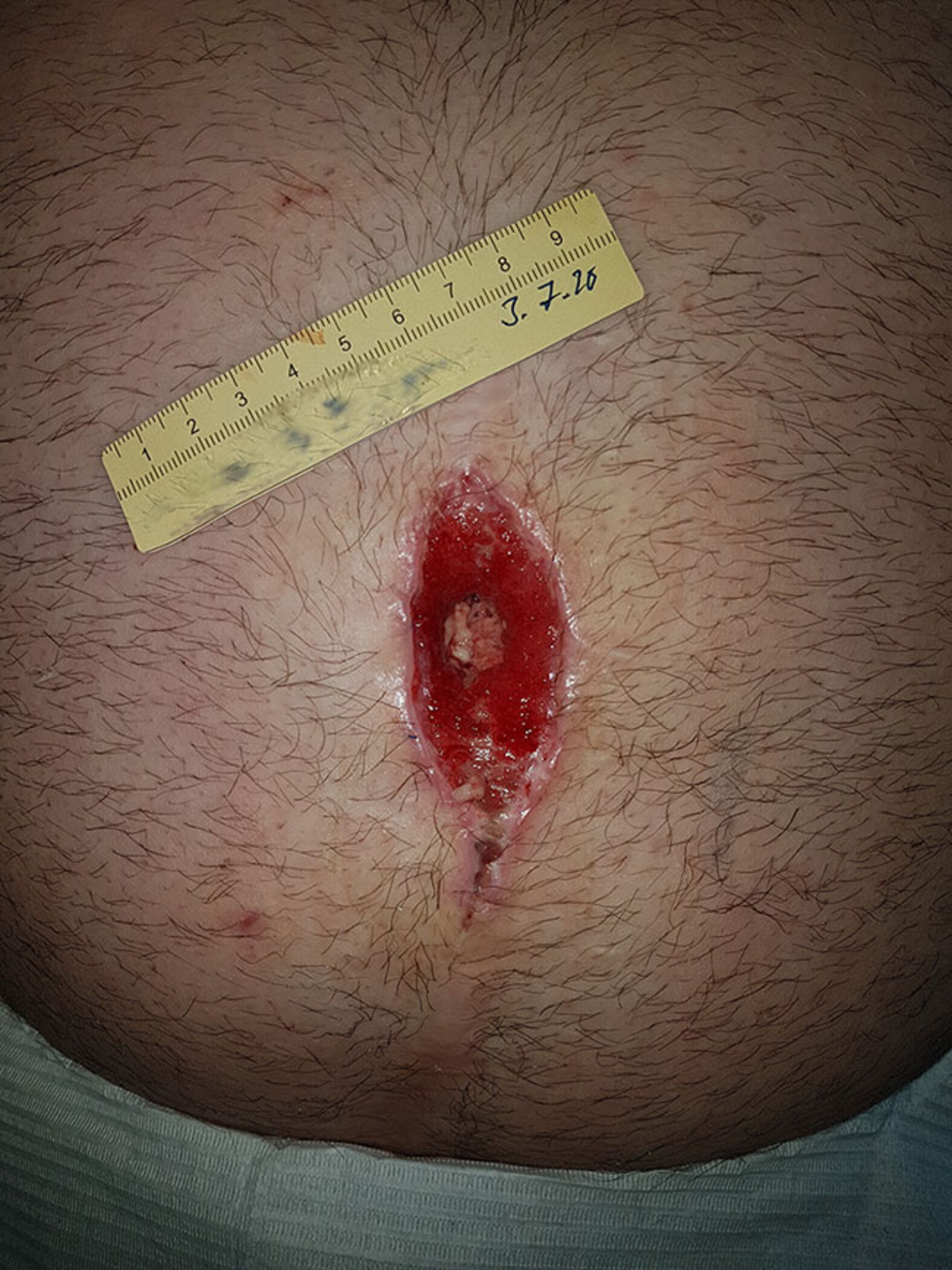 Nahtdehiszenz am Bauch