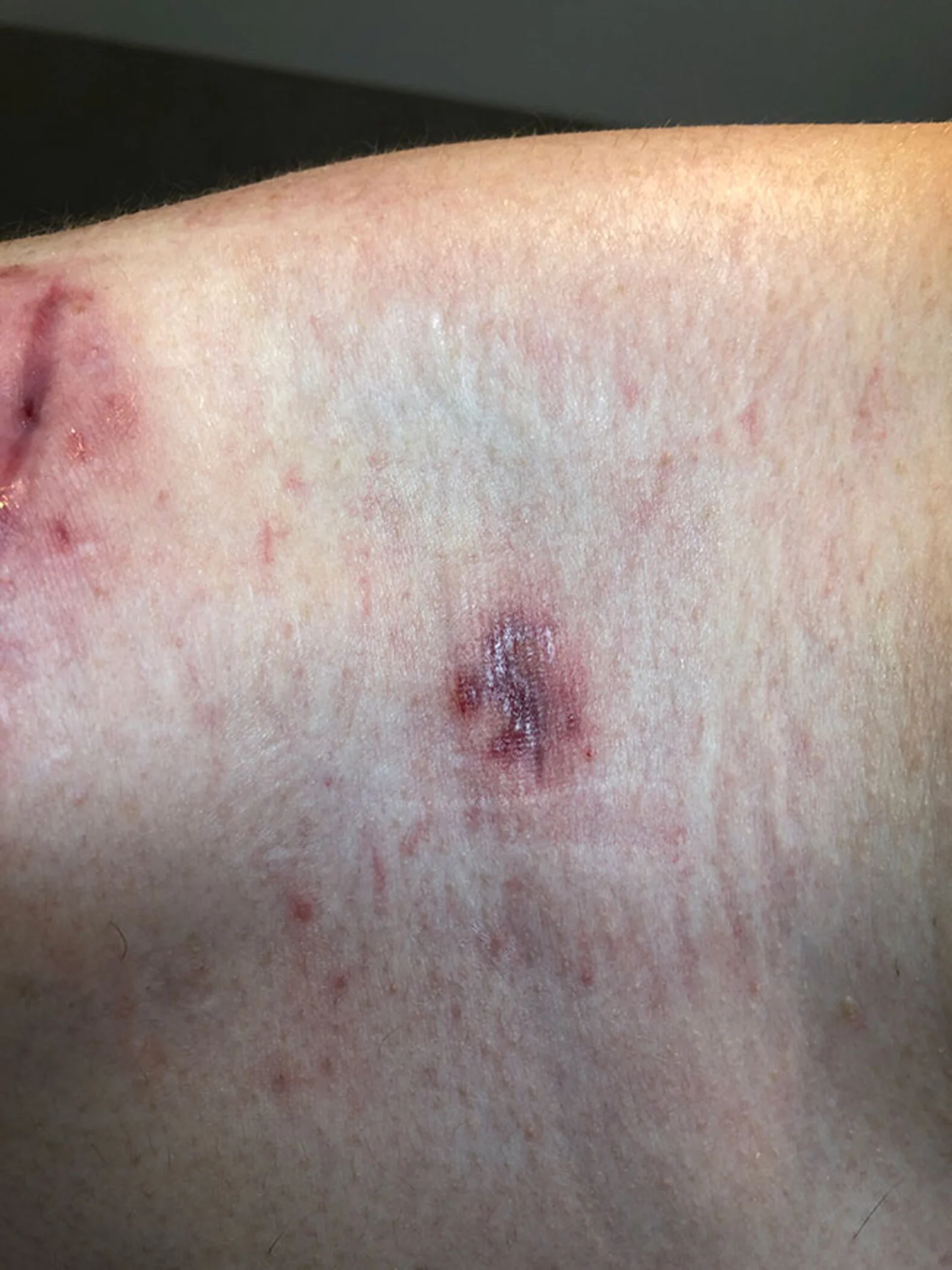 Fallbeispiel: Wundheilungsstörung postoperativ mit Infektion