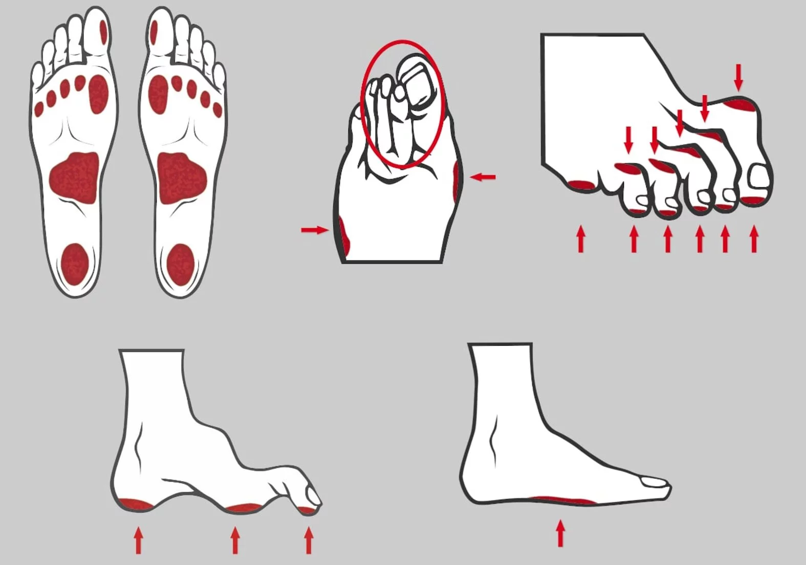 Von sensorischer Neuropathie/Muskeldystrophie potentiell betroffene kleine Fußmuskeln