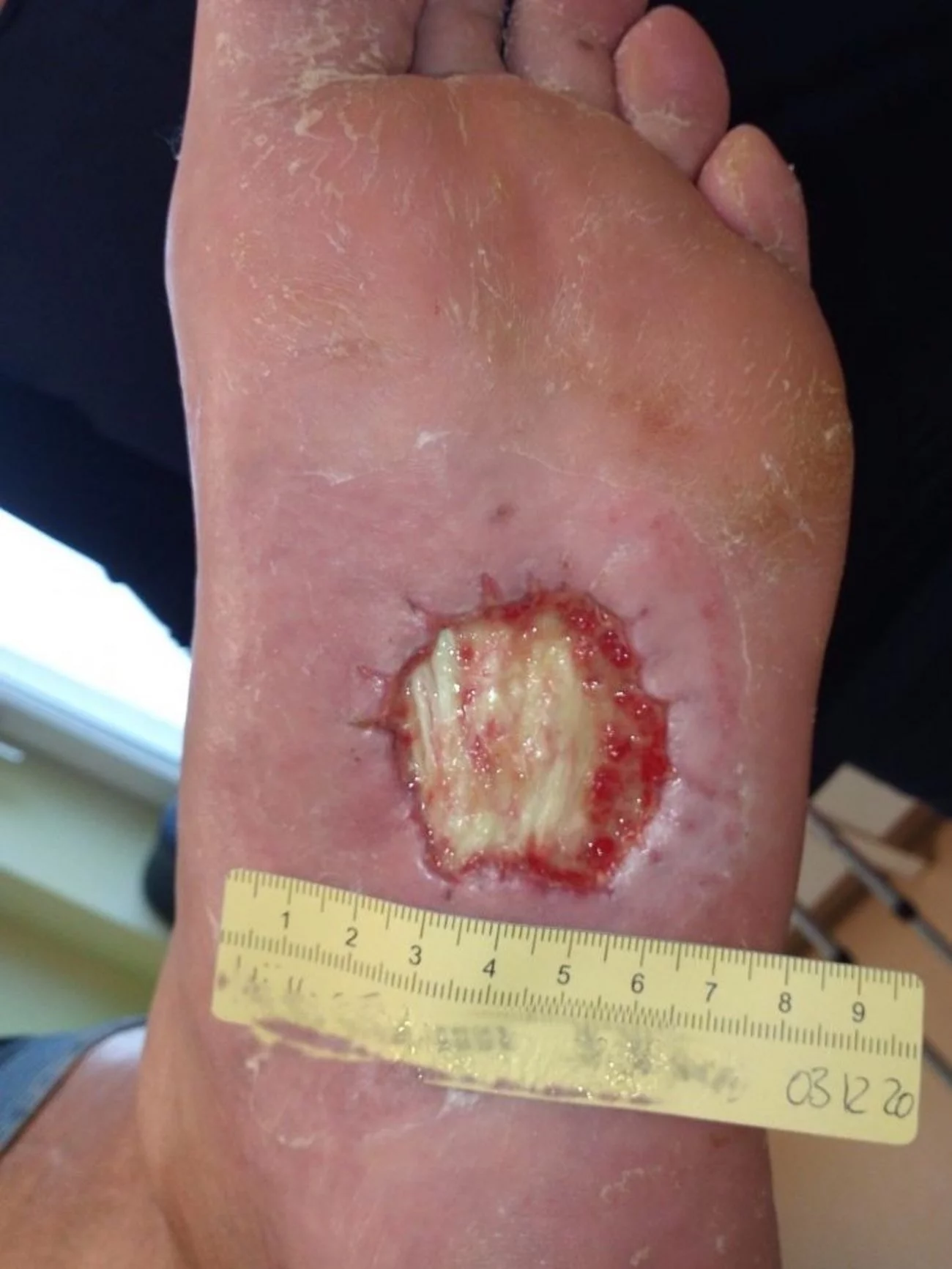 Diabetisches Fußulcus – wenig Granulationsgewebe