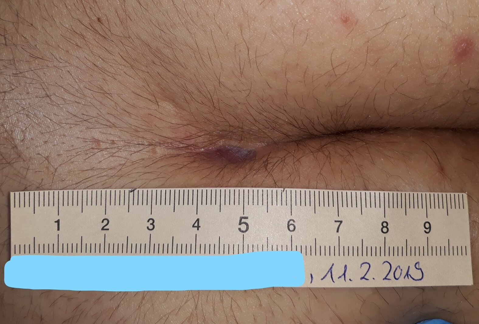 Abgeheilte Wunde nach operativer Behandlung eines Sinus pilonidalis