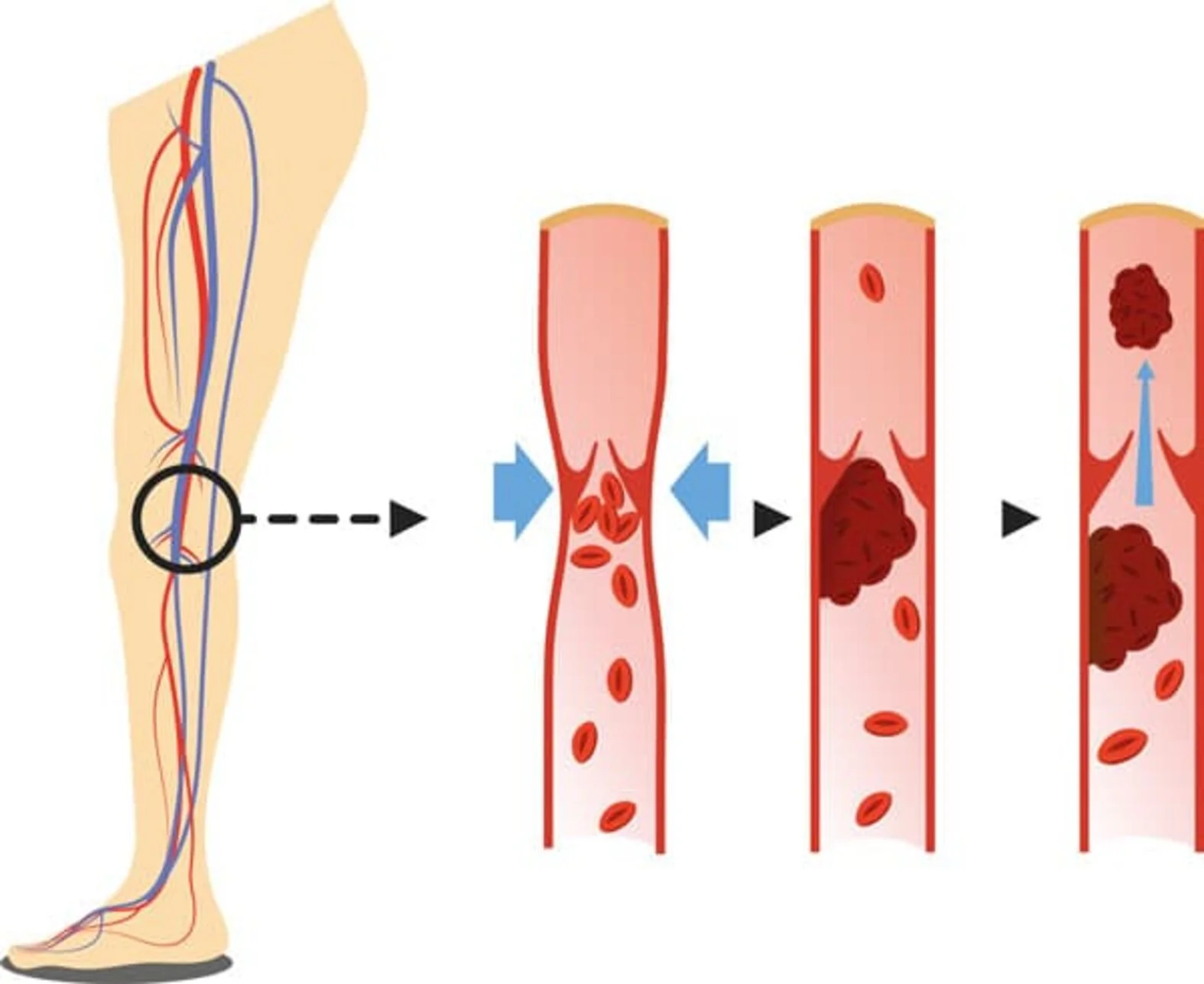 Entstehung einer Thrombose, schematische Darstellung