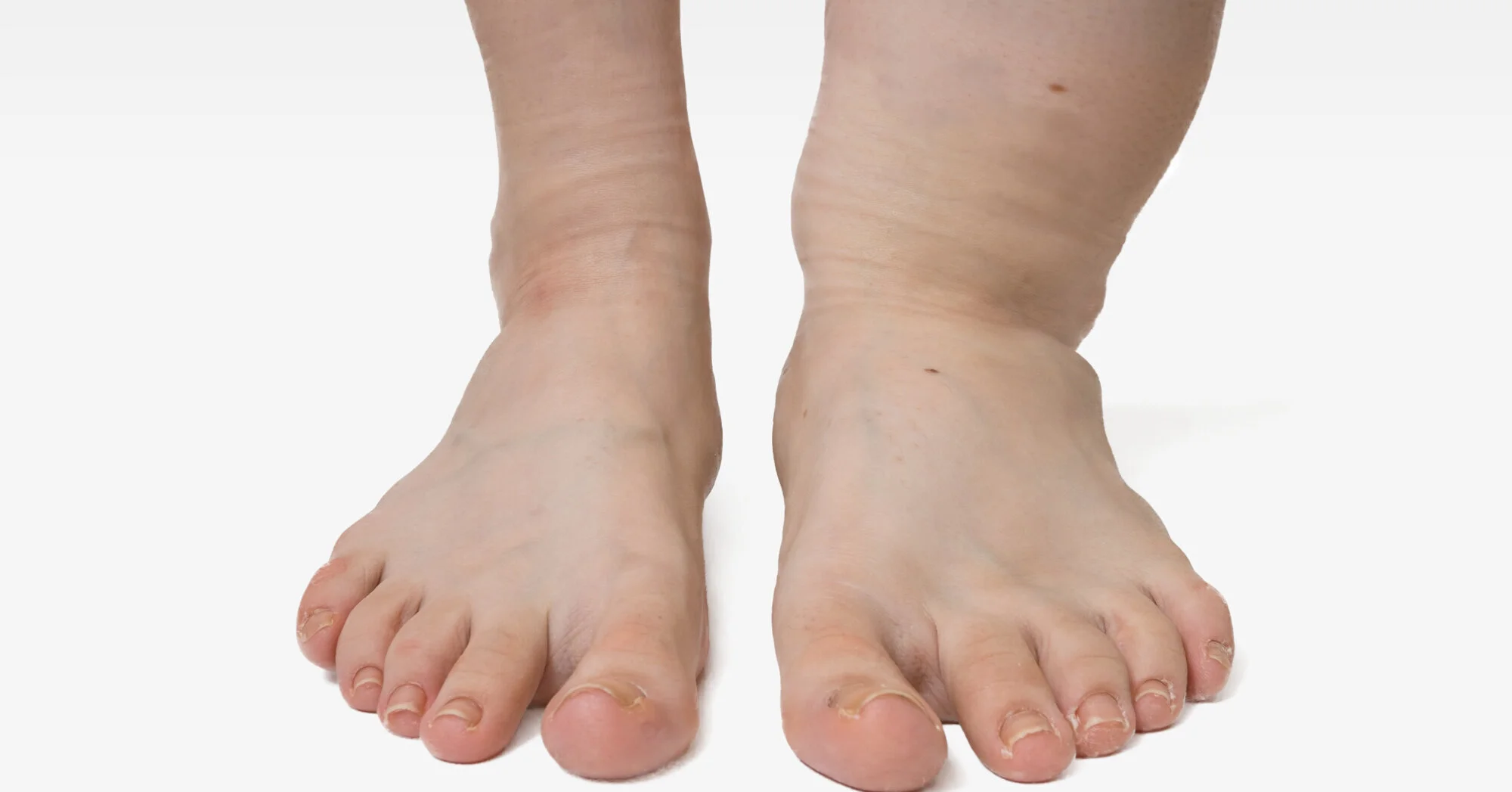 Lymphödeme Therapie und Differenzialdiagnose des Lymphödems