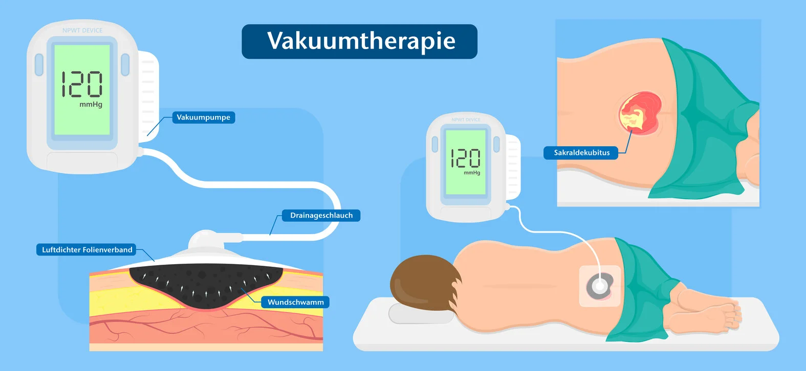 Vakuumtherapie: VAC, schematische Darstellung
