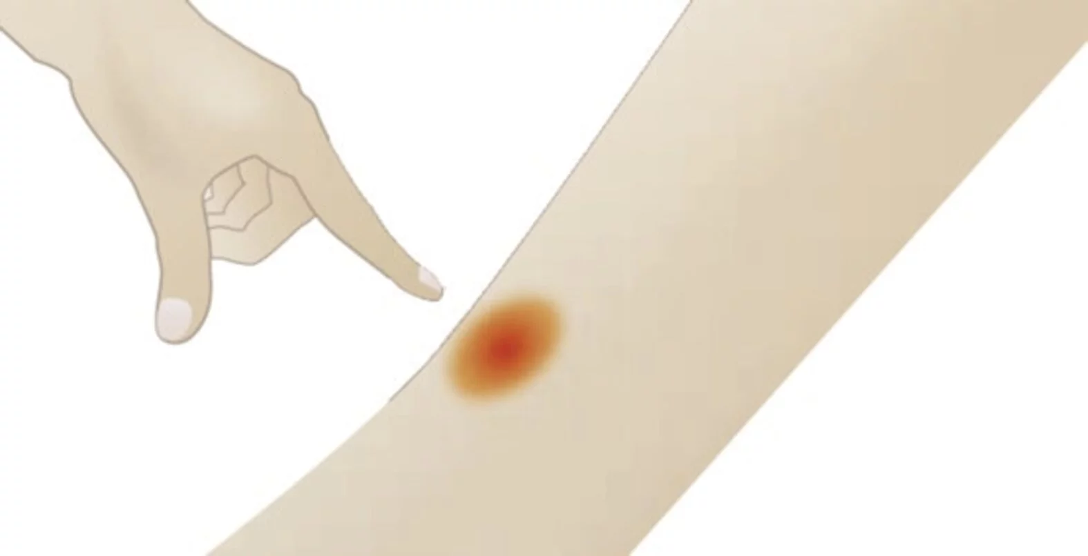Zeichnung: Finger drückte auf Bein mit rotem Punkt