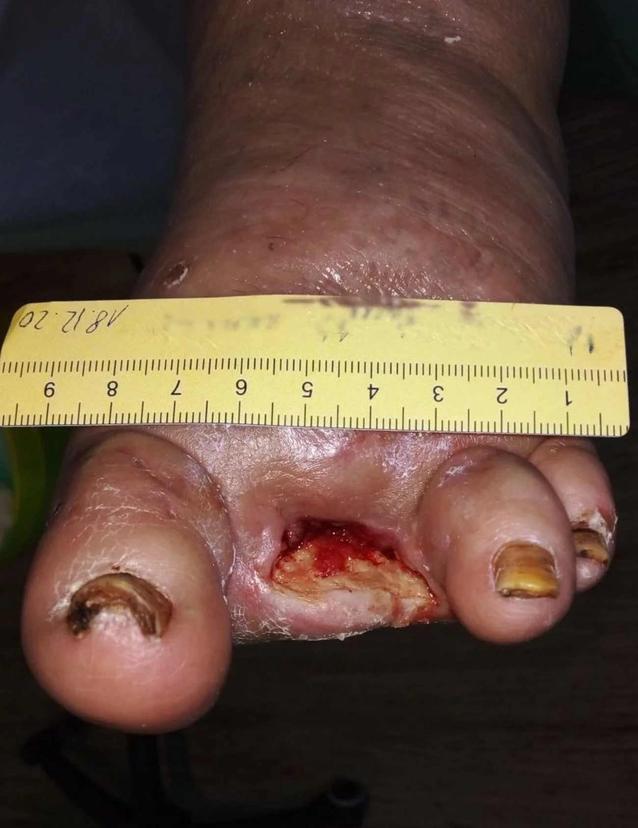 Diabetisches Fußsyndrom
