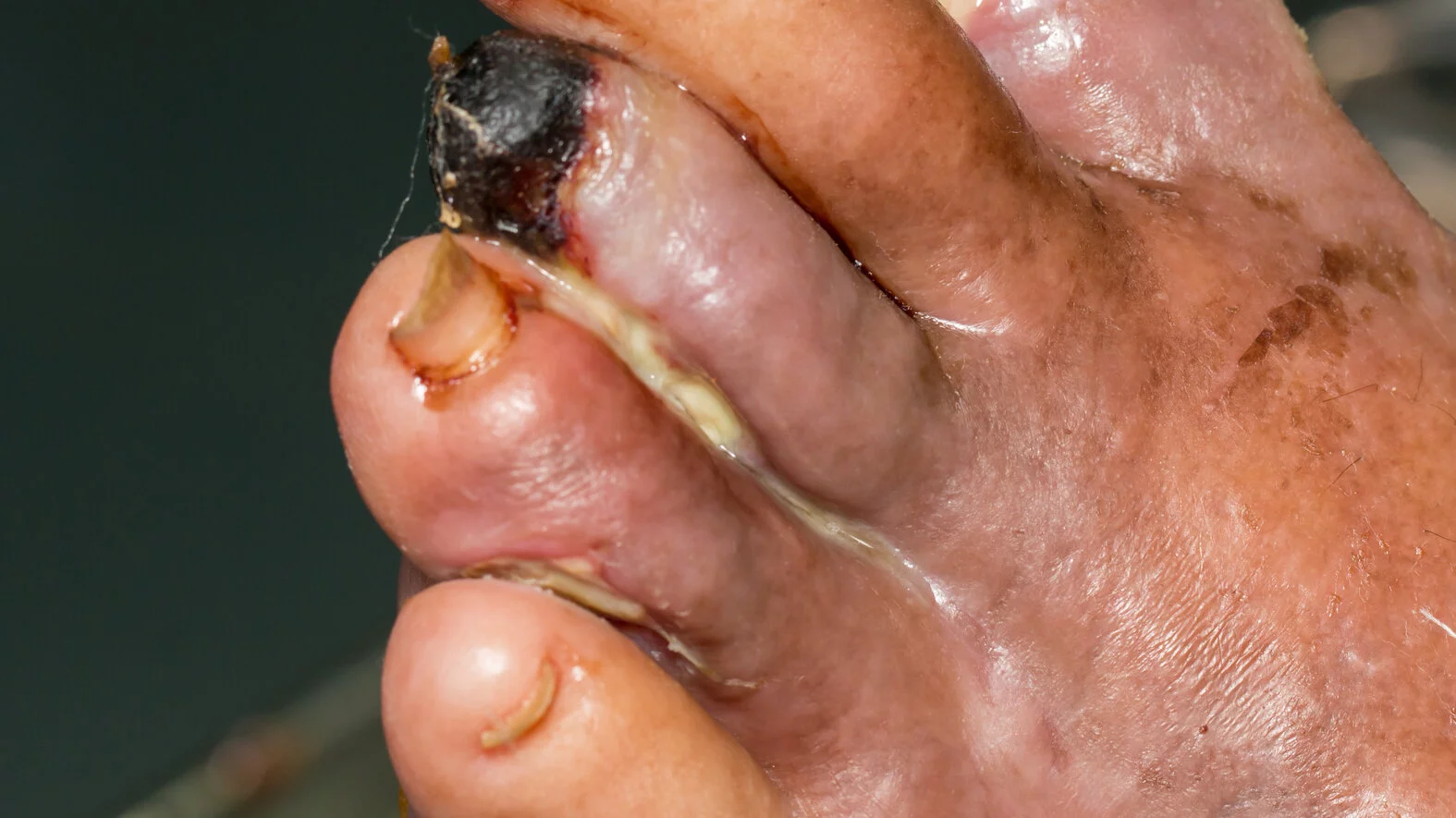 Nekrosen an Zehen, Eiter bei einem diabetischen Fußsyndrom