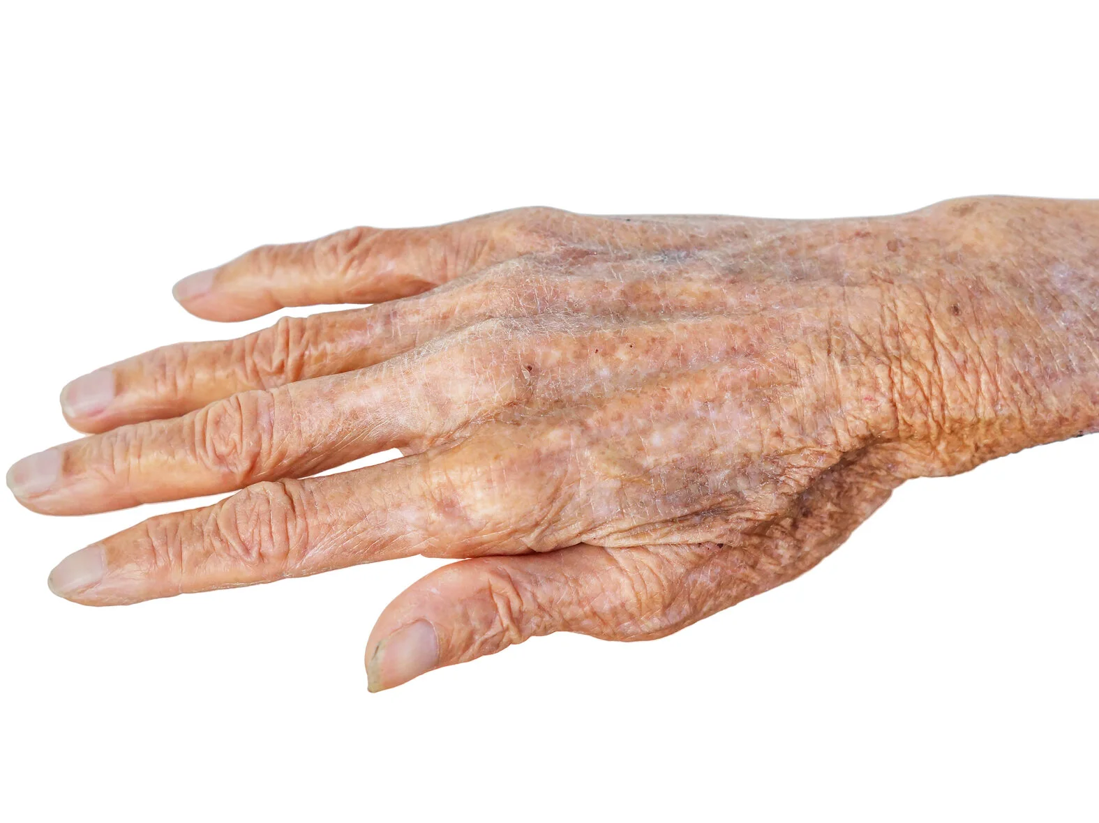 Altershaut Hand, dünne Haut mit Altersflecken
