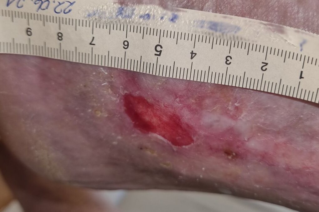 Ulcus cruris mixtum am linken Knöchel – nach 5 Monaten