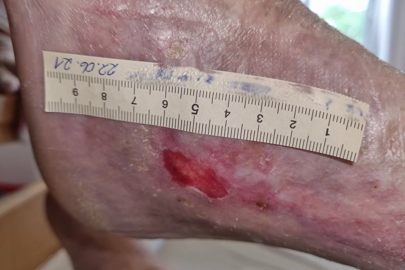 Ulcus cruris mixtum am linken Knöchel – nach 5 Monaten