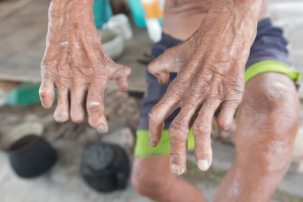 Lepra: Hände eines Patienten mit typischen Symptomen der Lepra