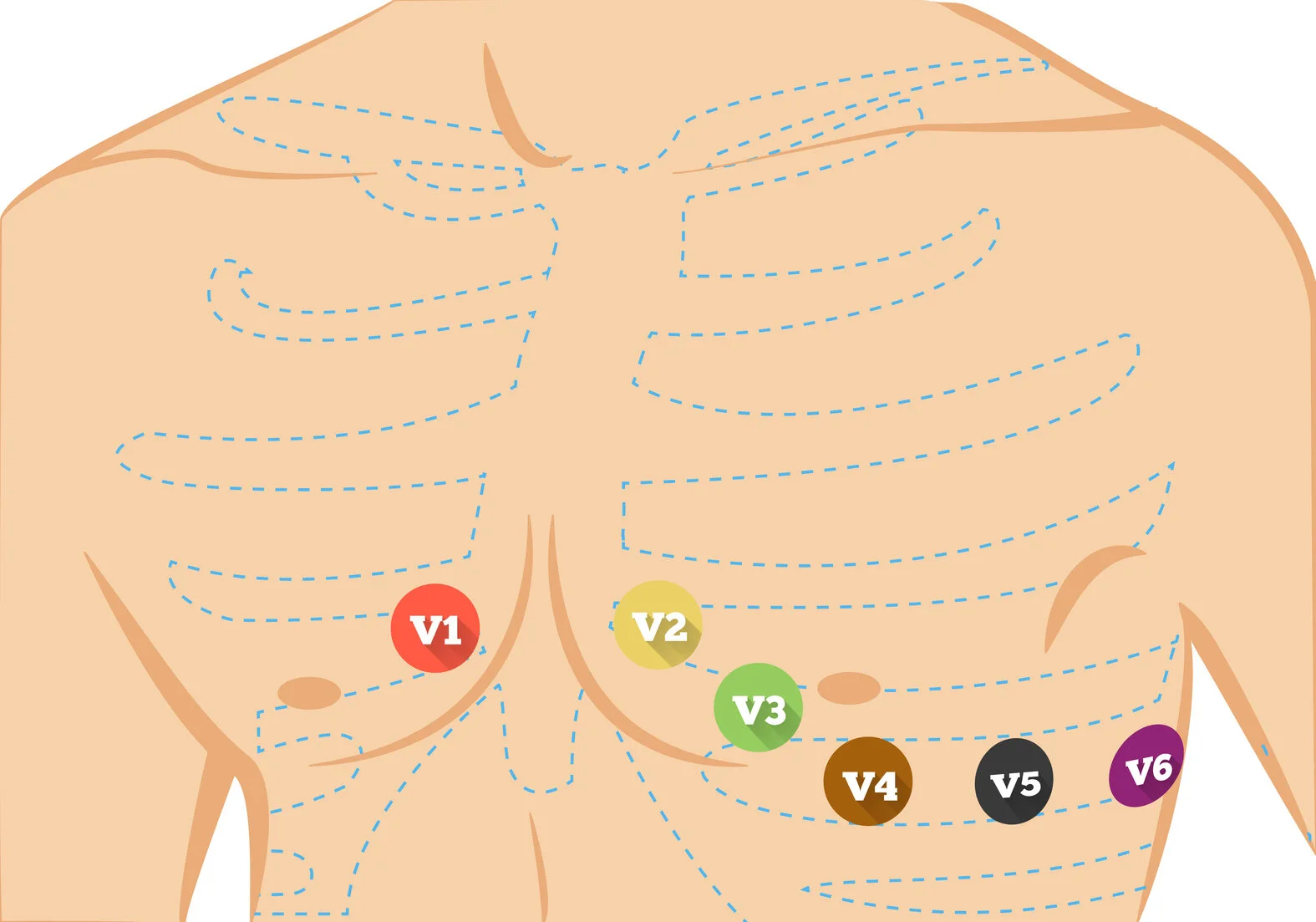 EKG, Position der Brustwandelektroden (Ableitung nach Wilson)