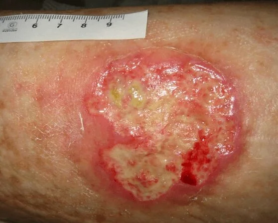 Fibrinbelag am Bein Fibrin und Fibrinbelag