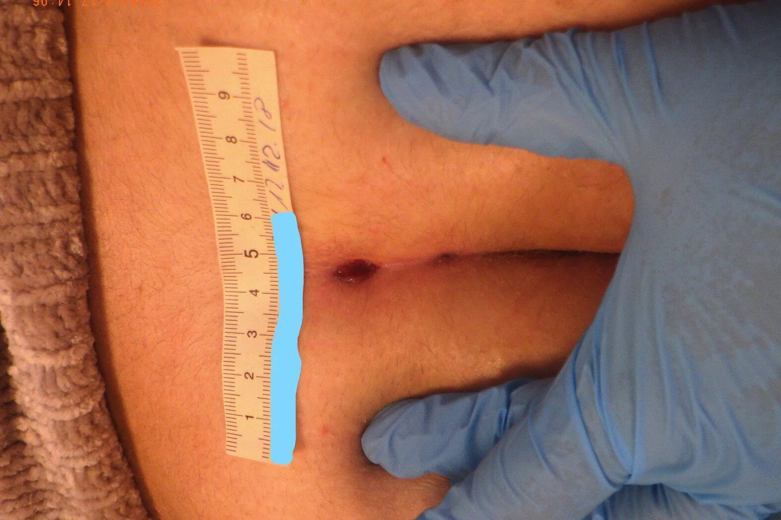 Fallbeispiel: Abszesssanierung nach Steißbeinfistel (Sinus pilonidalis)