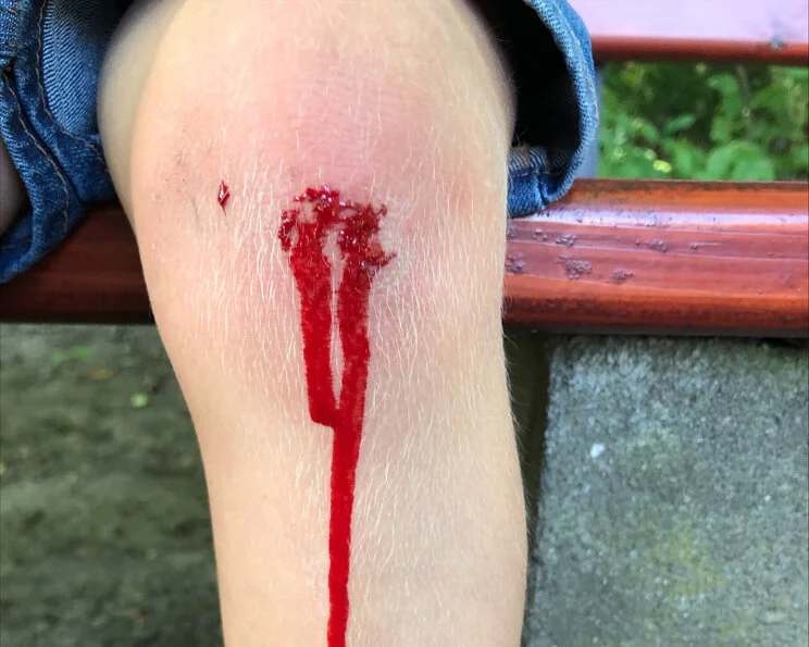 Wunde am Knie, Kind: Einsetzende Hämostase Hämostase - Blutstillungsphase, Phase der Wundheilung