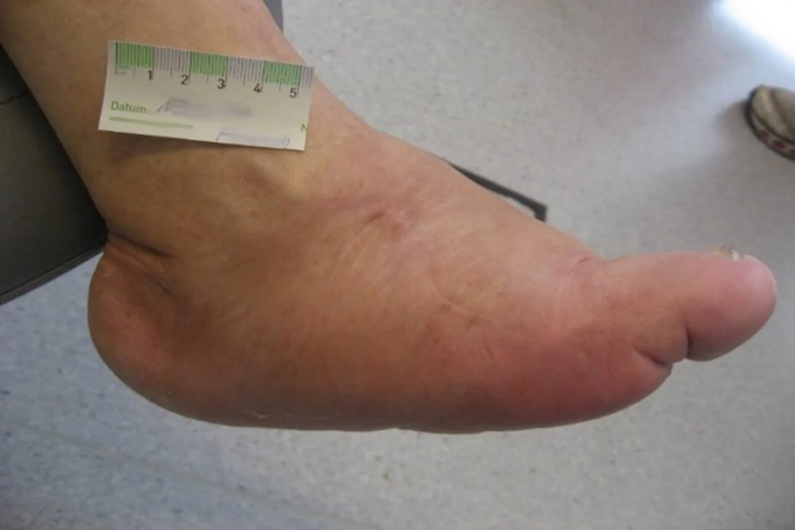 CharcotFuß oder CharcotArthropathie beim Diabetischen Fuß