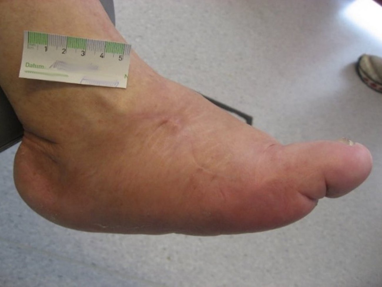 Angeschwollener Fuß mit Charcot-Arthropathie
