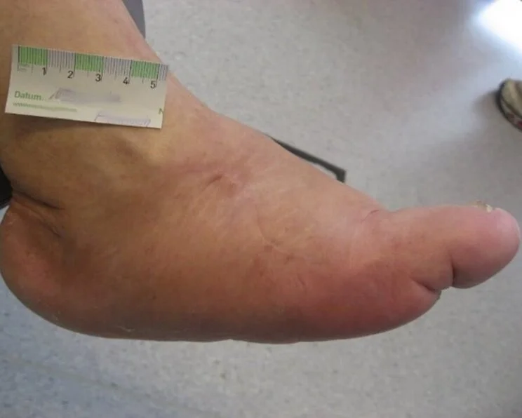 charcot-arthropathie Charcot-Fuß