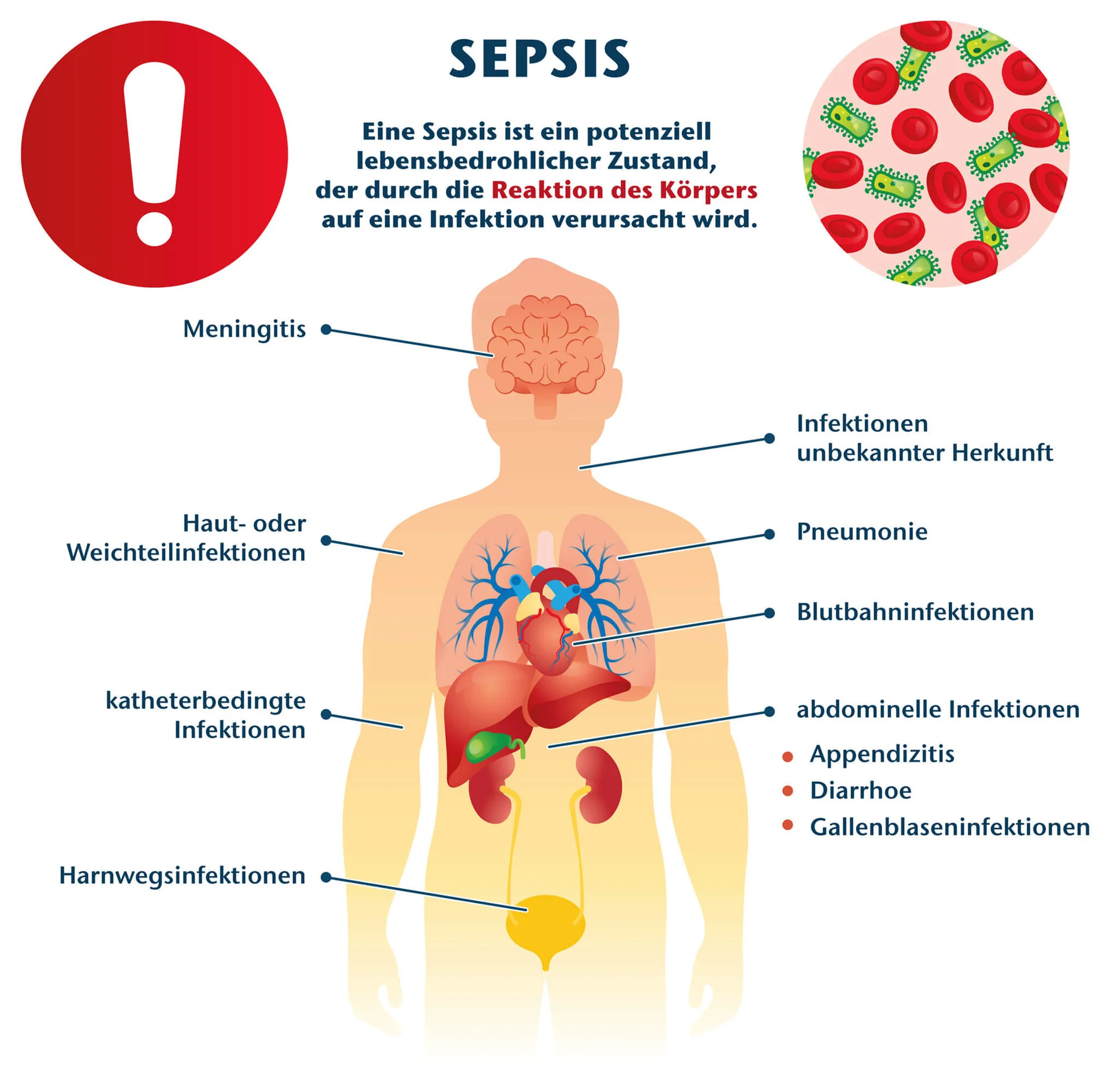 Wie reagiert der Körper auf eine Sepsis?