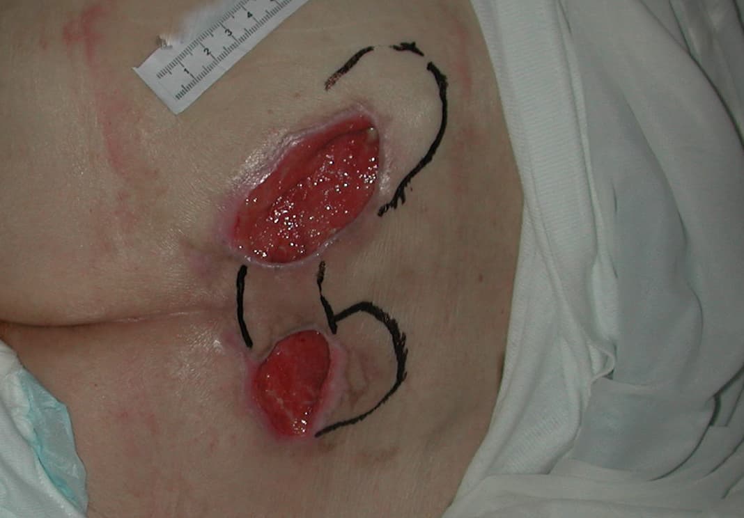 Dekubitus der Kategorie 4 am ersten Tag