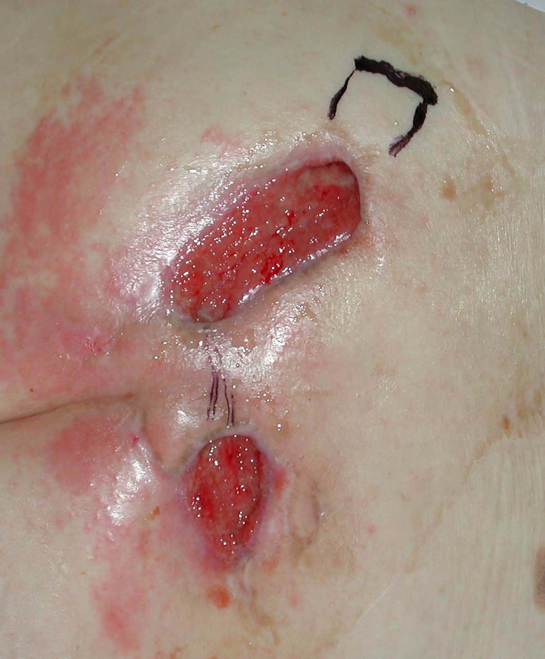 Dekubitus der Kategorie 4 am Tag 35