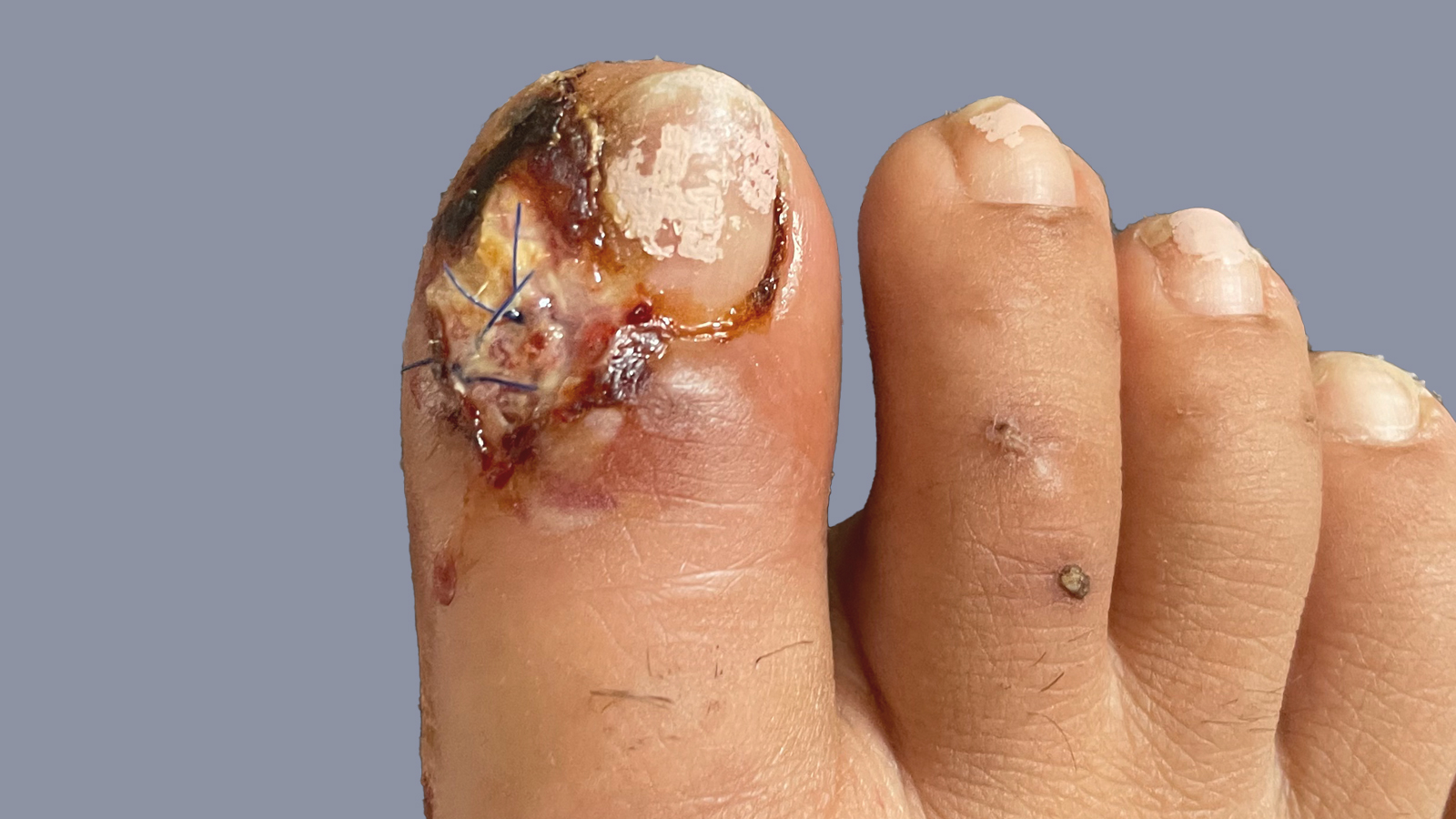 Nagelbettentzündung nach Inzision und unzureichender Nachsorge