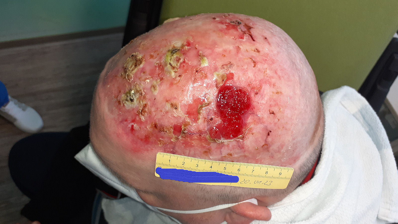 Wunden am Kopf bei Hautkrebs