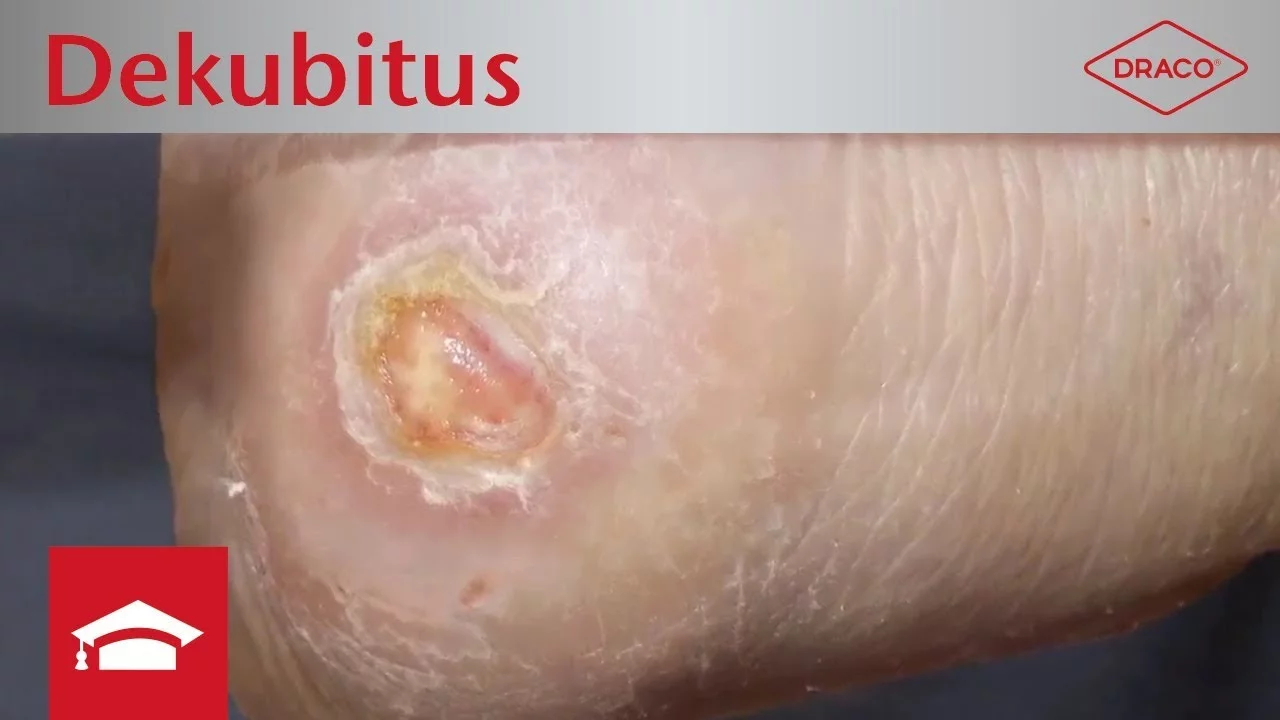 Video: Dekubitus, Wundbeschreibung und Dokumentation der Wunde
