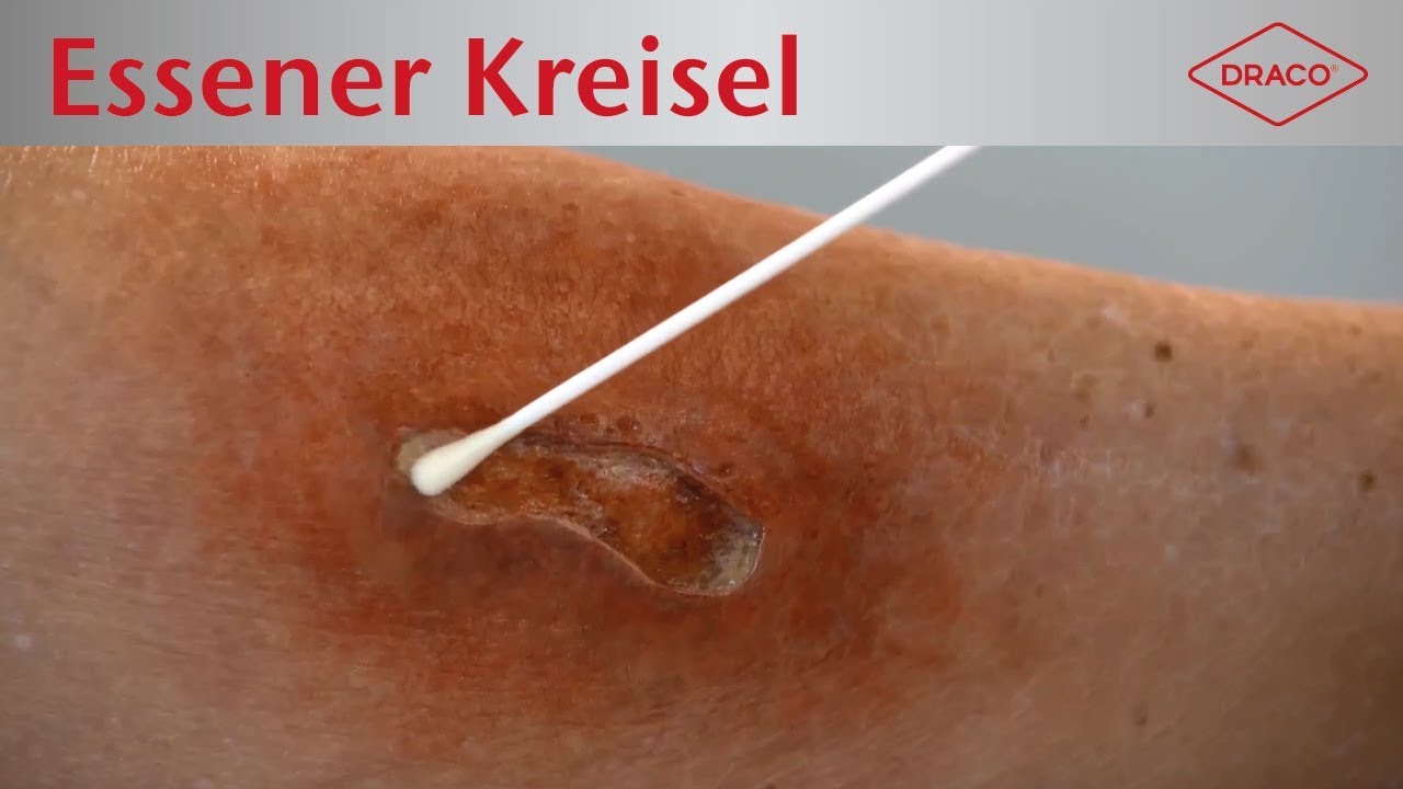 Warum Darf Eine Geklebte Wunde Nicht Nass Werden Infizierte Wunden: Versorgung septischer Wunden, Wundinfektion - DRACO