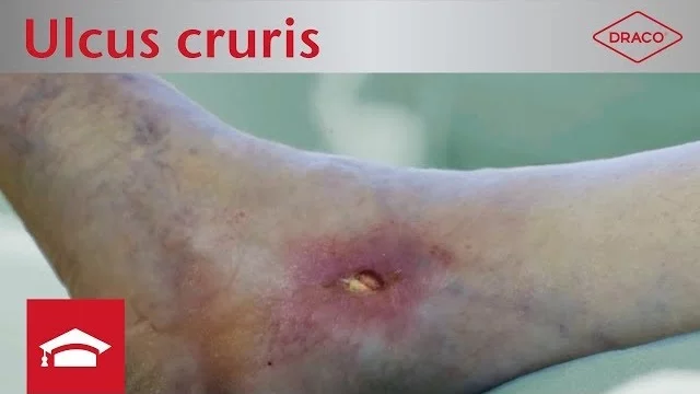 Ulcus cruris Vorschaubild