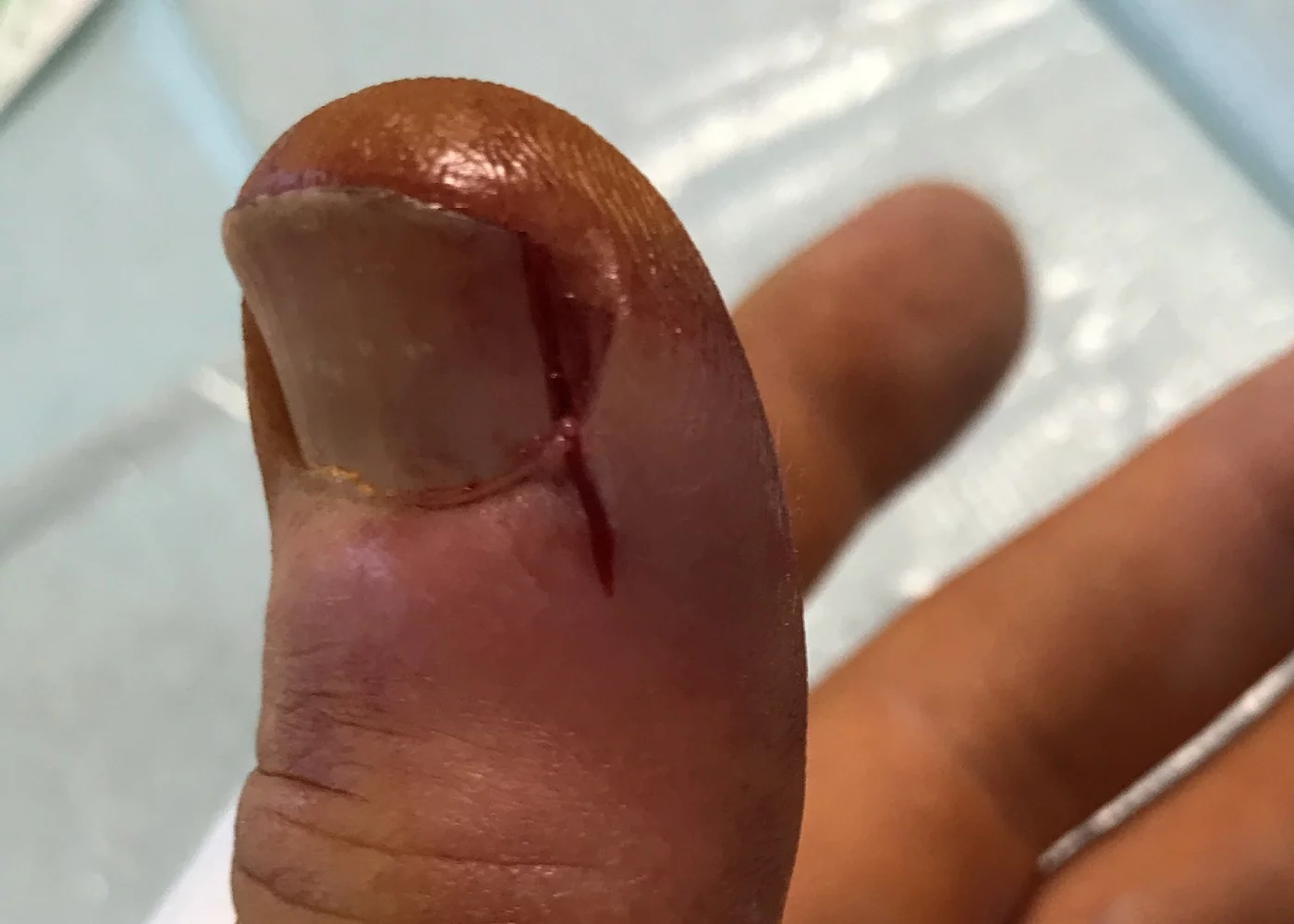 Iatrogene Wunde am Nagelbett Iatrogene Wunde am Nagelbett (Daumen)