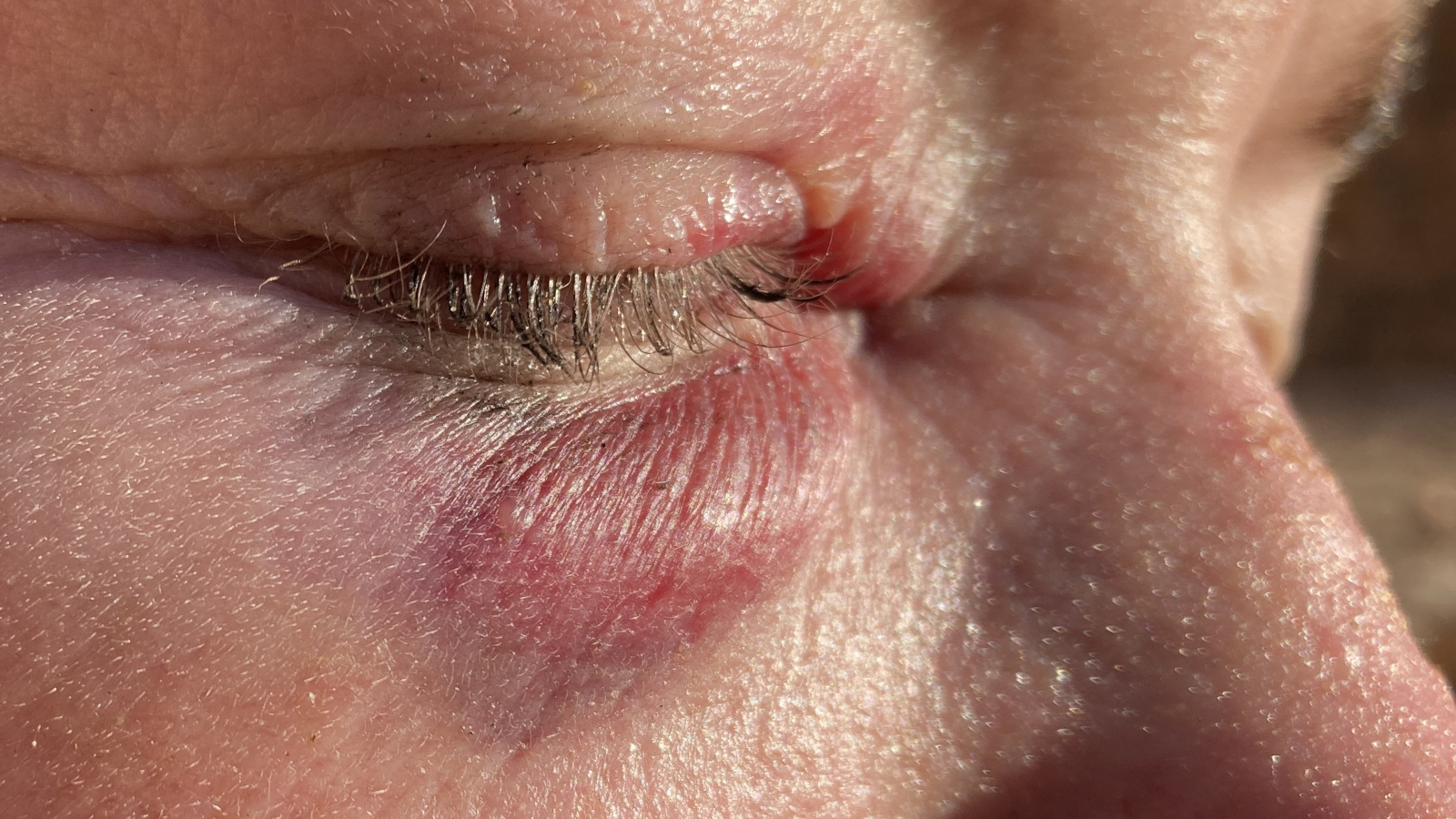 Plötzliche Einblutung Unter Dem Auge